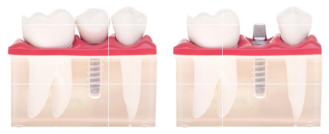 implant dentaire hongrie 2
