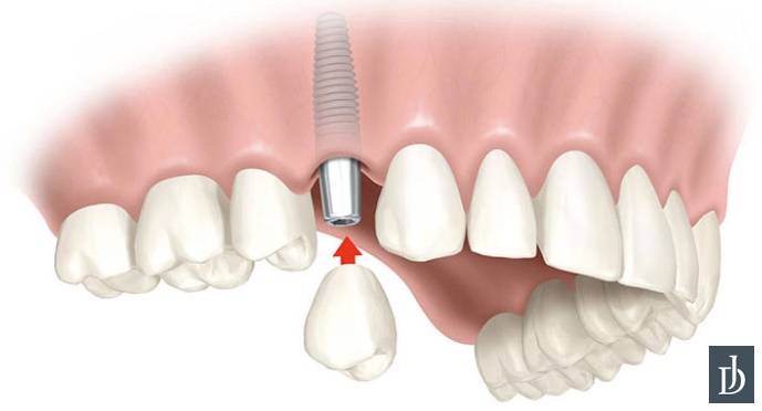 implant dentaire avantages