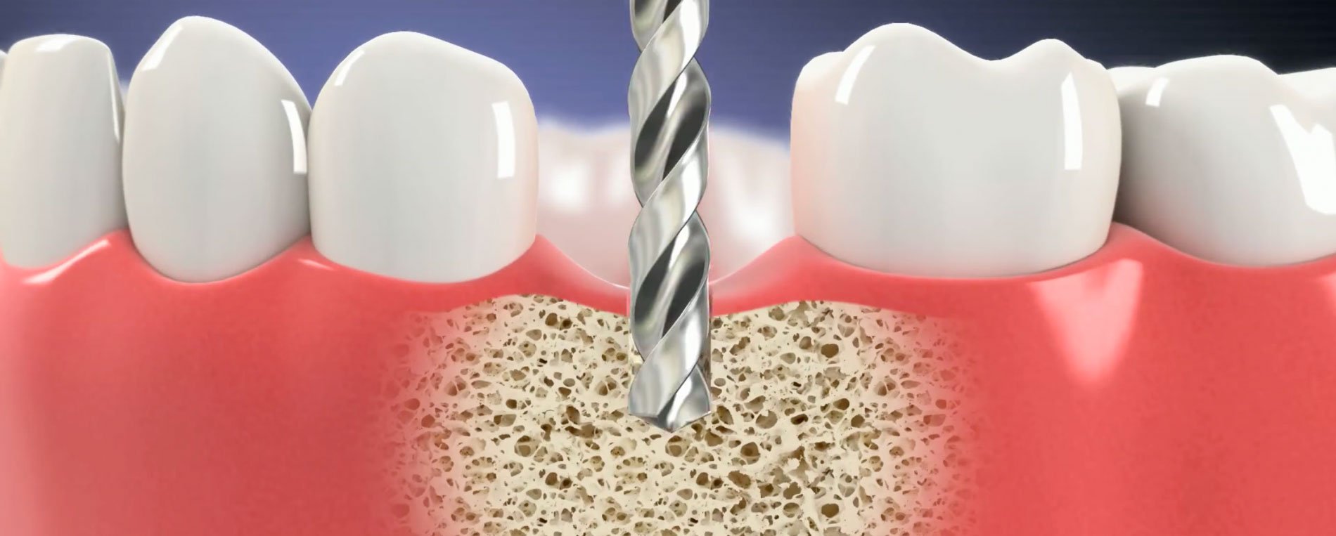 implant dentaire video jildent clinique