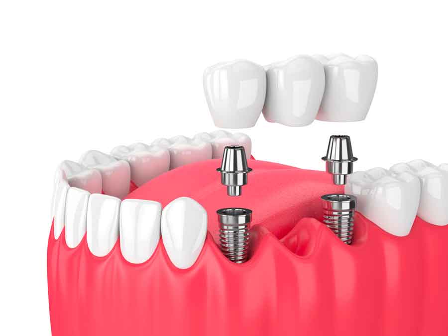 bridge sur implant dentaire
